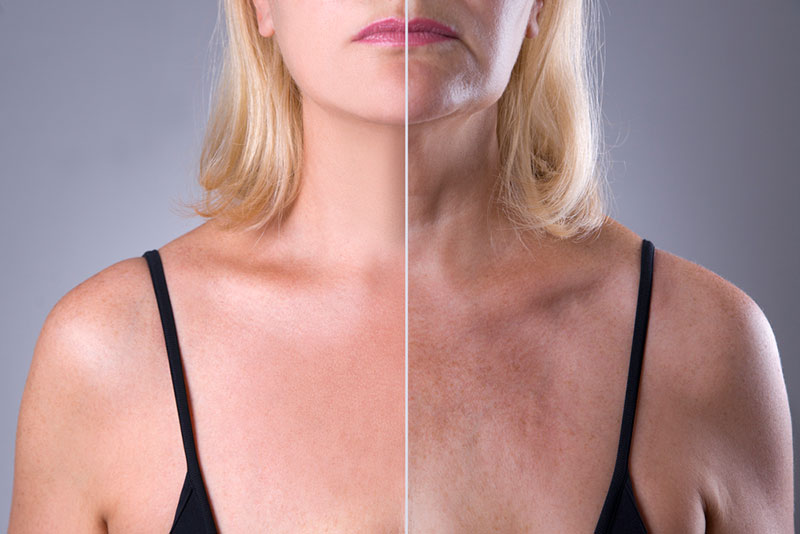 פיגמנטציה בעור - לפני ואחרי